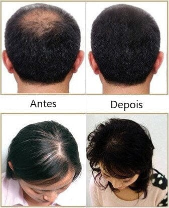 Escova a Laser – Terapia para Crescimento Capilar HairRise Saude & Beleza (Escova de cabelo 2) Dm Stores 